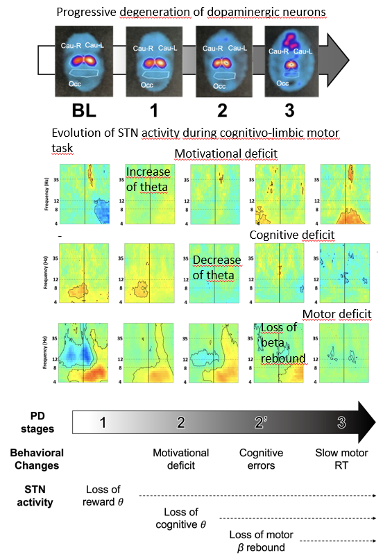 Schéma expliquant la dégénérescence progressive des neurones dopaminergiques