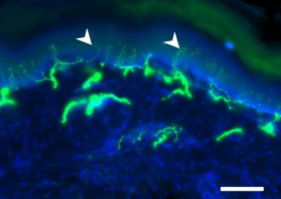 Image au microscope montrant les petites terminaisons des nerfs dans la peau de la patte arrière d’un rat traité avec deux molécules : le paclitaxel, un médicament de chimiothérapie, et Carba1, une molécule qui protège les nerfs. Les fibres nerveuses (en 