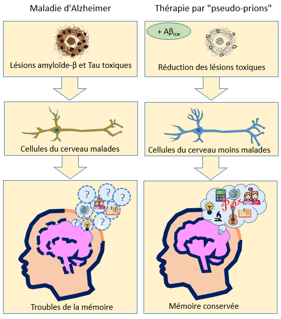 La thérapie par les pseudo-prions Aβice réduit les lésions toxiques de la maladie d'Alzheimer