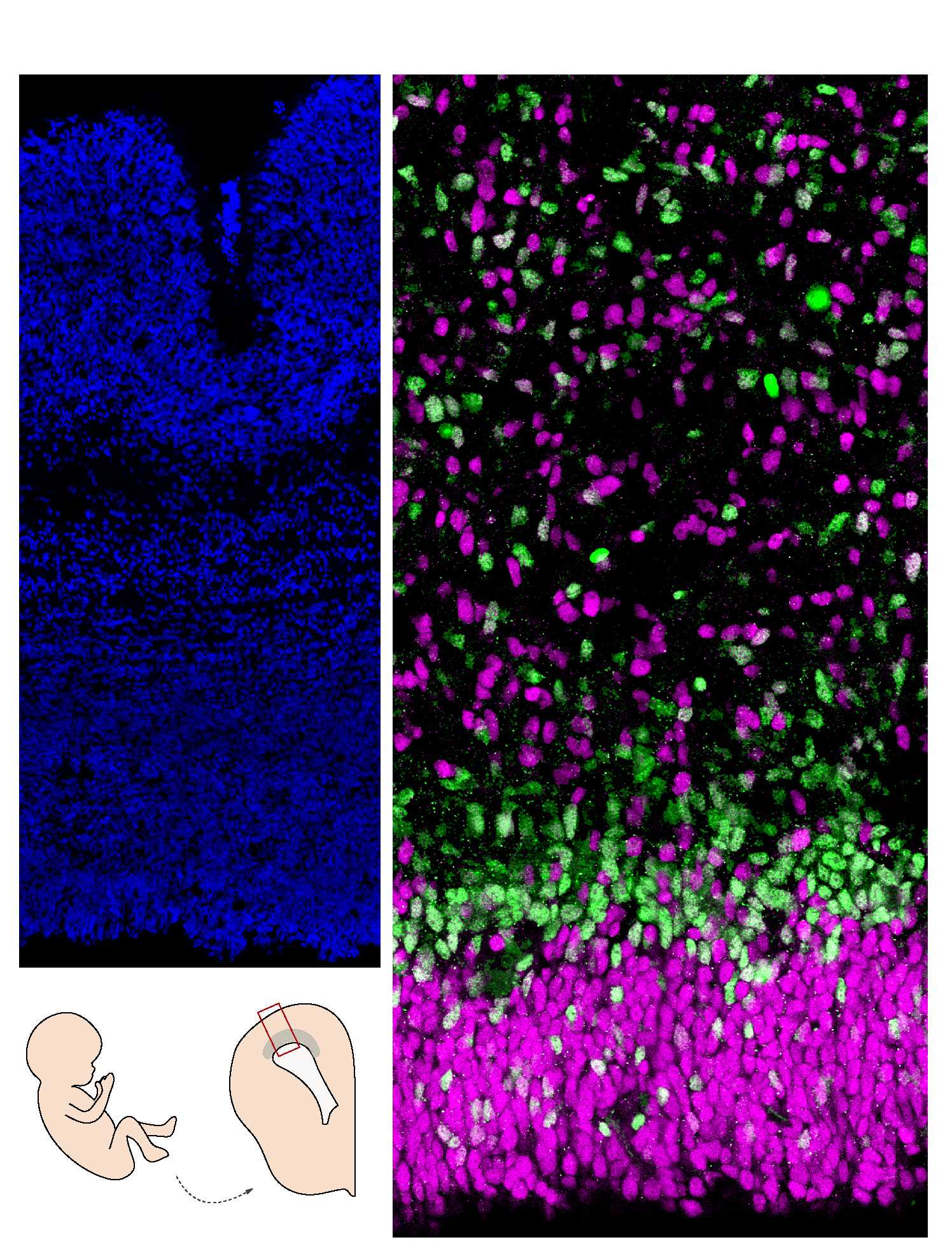 Coupe de cerveau humain (cortex). À gauche, les noyaux sont marqués en bleu; à droite, les cellules progénitrices en magenta sont moins engagées dans la différenciation neuronale que celles en vert.  ©Monia Barnat/Grenoble Institut des Neurosciences/Inser