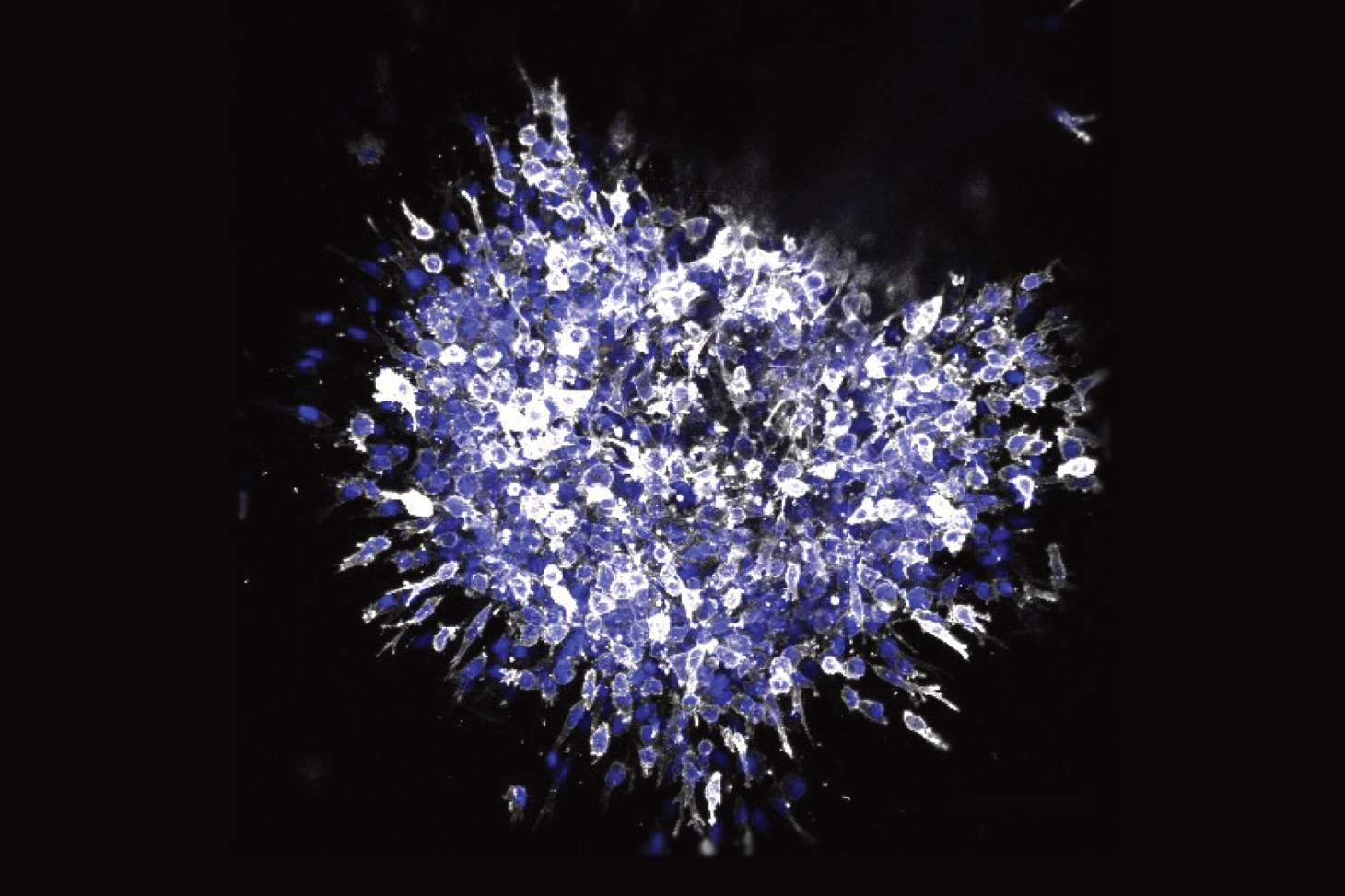 Illustration de la capacité d'invasion des cellules cancéreuses du sein avec stimulation par SMYD2 ©Casanova et al.